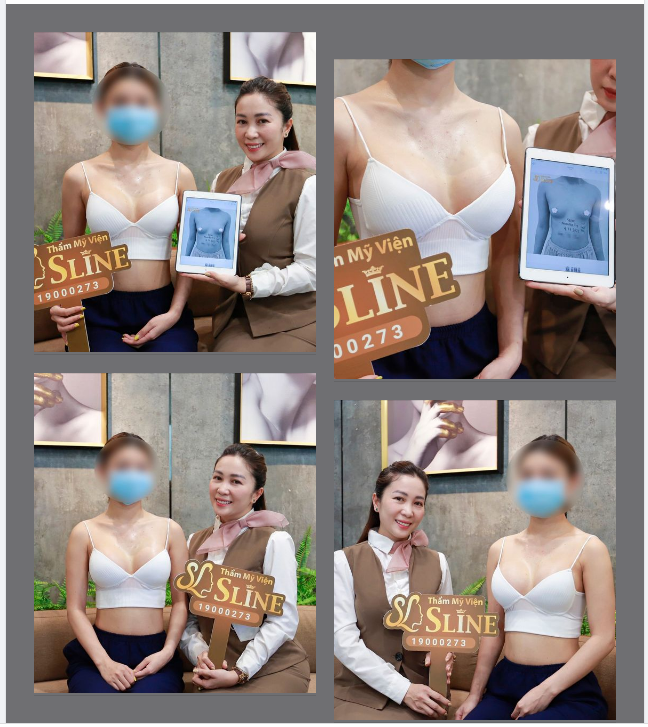 Feedback nâng ngực sau 14 ngày.