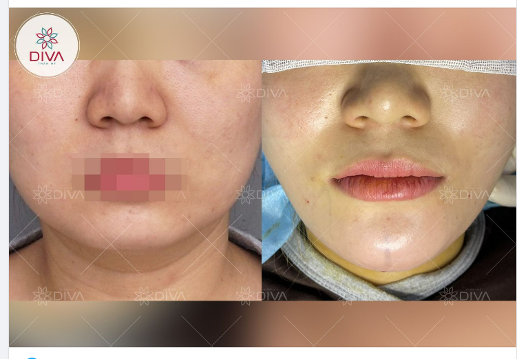 KẾT QUẢ CẤY MỠ COLEMAN CẰM: GƯƠNG MẶT CÂN ĐỐI, CẰM CHUẨN VLINE