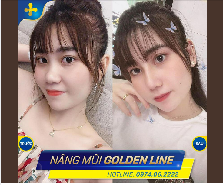 SAU NÂNG MŨI KHUÔN MẶT SẼ THAY ĐỔI NHƯ THẾ NÀO ️