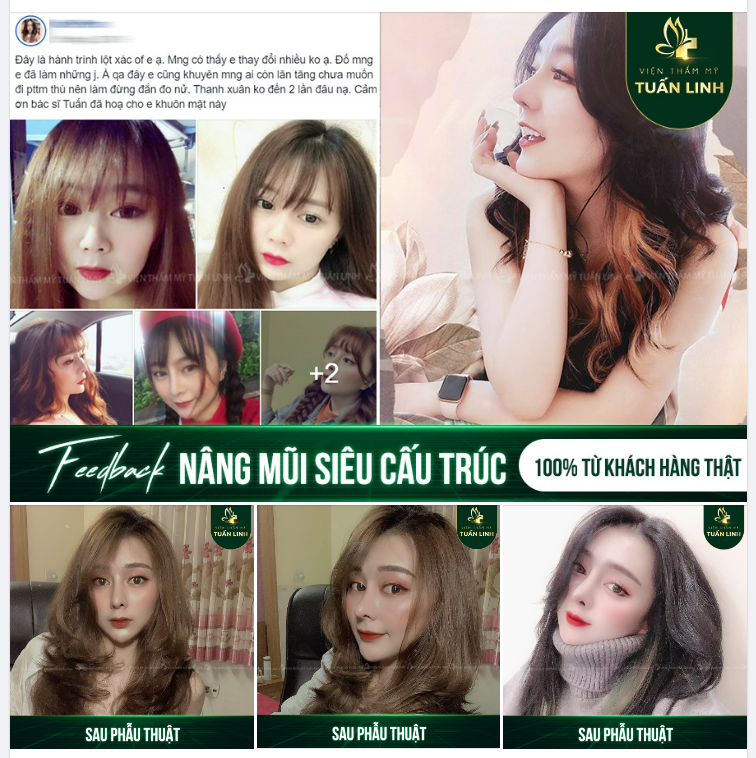 FEEDBACK NÂNG MŨI SIÊU CẤU TRÚC ĐẸP XUẤT SẮC