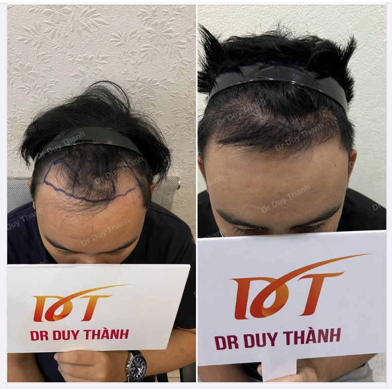 3 THÁNG 25 NGÀY SAU CẤY TÓC
