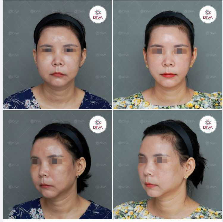 KẾT QUẢ SỬA LỖI CẤY MỠ HỎNG SAU 2 TUẦN: CÁC VÙNG MỠ VÓN CỤC ĐƯỢC XỬ LÍ HOÀN TOÀN