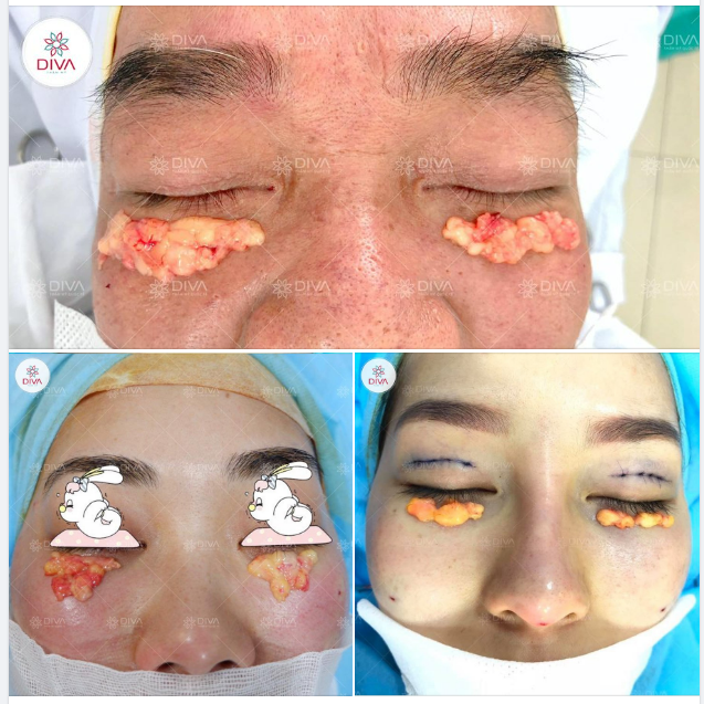 TÚI MỠ MÍ MẮT DƯỚI - THỦ PHẠM LÀM ĐÔI MẮT U BUỒN, MỆT MỎI !