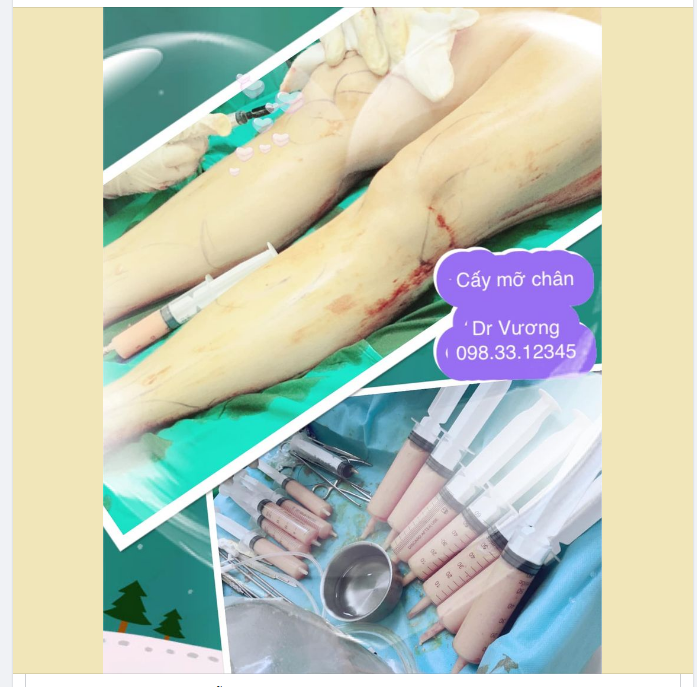 Cấy mỡ vùng chân (vùng gối, cẳng chân bàn chân) với Dr Vương