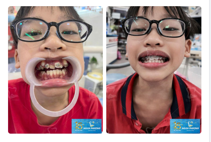 Cha mẹ có biết có thể niềng răng cho con từ lớp 1?