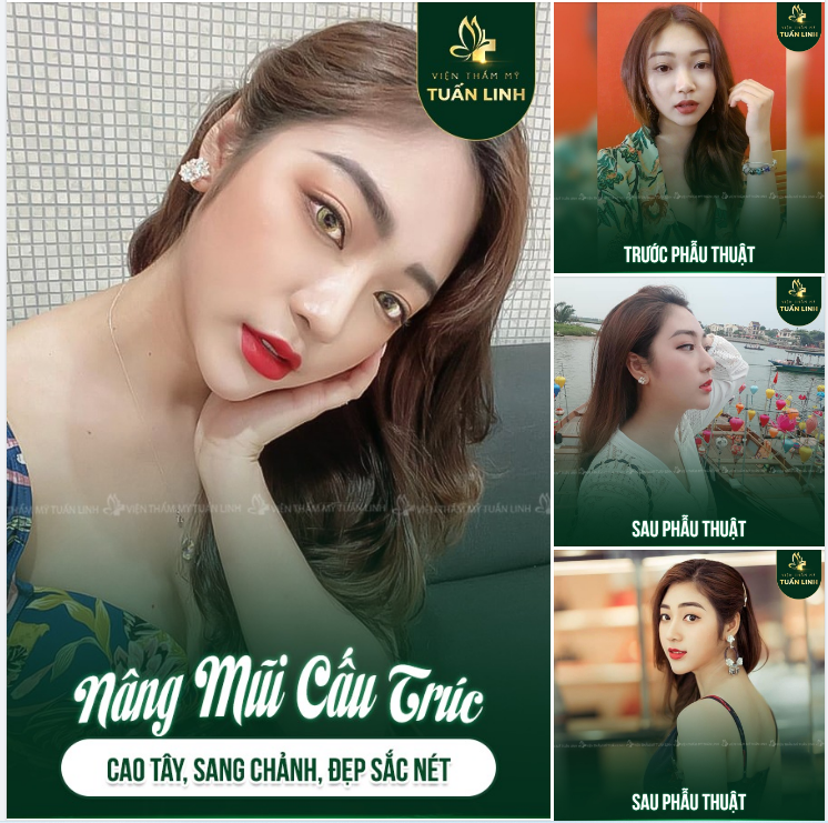 Cô nàng 9x xinh đẹp không hối hận với quyết định nâng mũi tại tuấn Linh