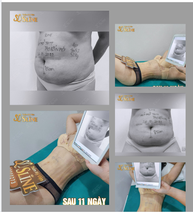 Khoe vòng 2  sau 11 ngày hút mỡ với Ekip Sline.