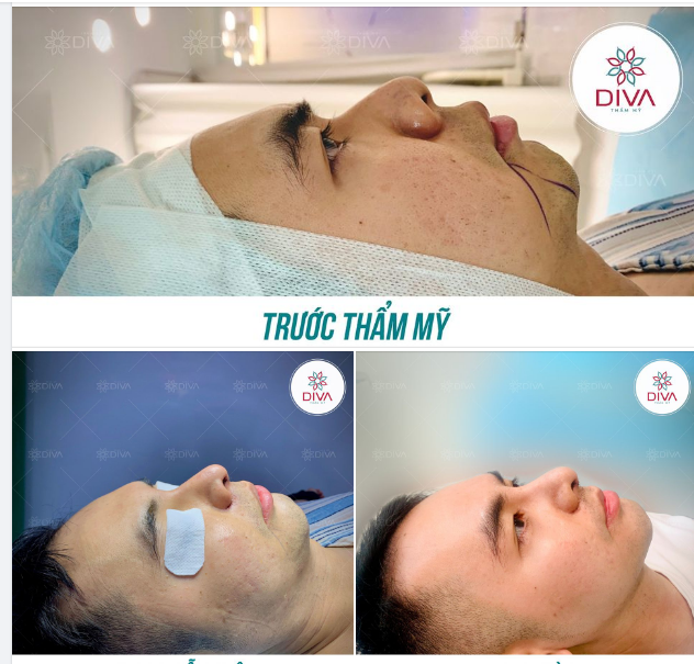KẾT QUẢ NÂNG MŨI TÁI CẤU TRÚC GHÉP SỤN TỰ THÂN + CẮT CÁNH MŨI SAU 10 NGÀY
