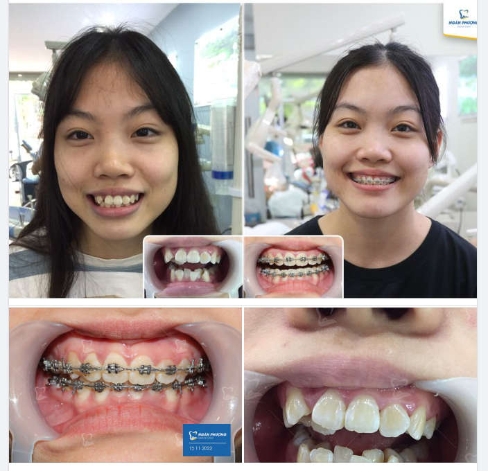 Chúc mừng cô gái Mai Thuỳ đã được tháo niềng