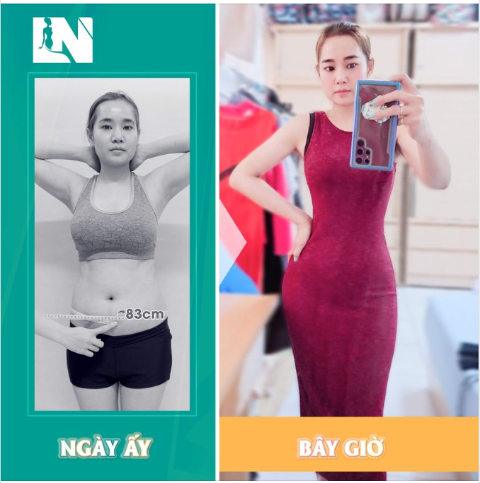 Hình ảnh của Chị Lan 36 tuổi (đến từ Kiên Giang) nhưng hiện sinh sống, làm việc tại Đài Loan sau ca thực hiện  hút mỡ tạo dáng thẩm mỹ.