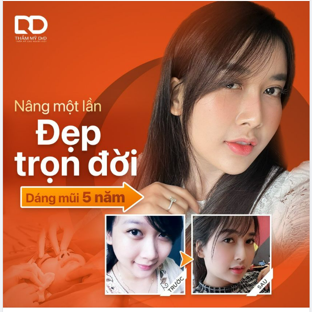 NÂNG MŨI 1 LẦN - ĐẸP TRỌN 1 ĐỜI