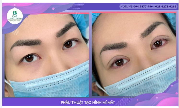 Đôi mắt không đều , nhiều nếp mí, trũng Hai mí rõ, tròn, đều và long lanh hơn CHỈ NGAY SAU 15 phút phẫu thuật.