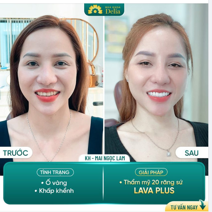 Khắc phục răng ố vàng, khấp khểnh nhanh chóng chỉ sau 02 lần hẹn