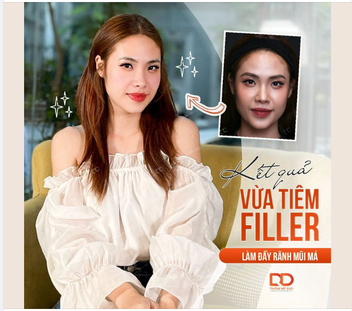 5 PHÚT TIÊM FILLER - TRẺ HOÁ GƯƠNG MẶT TỨC THÌ
