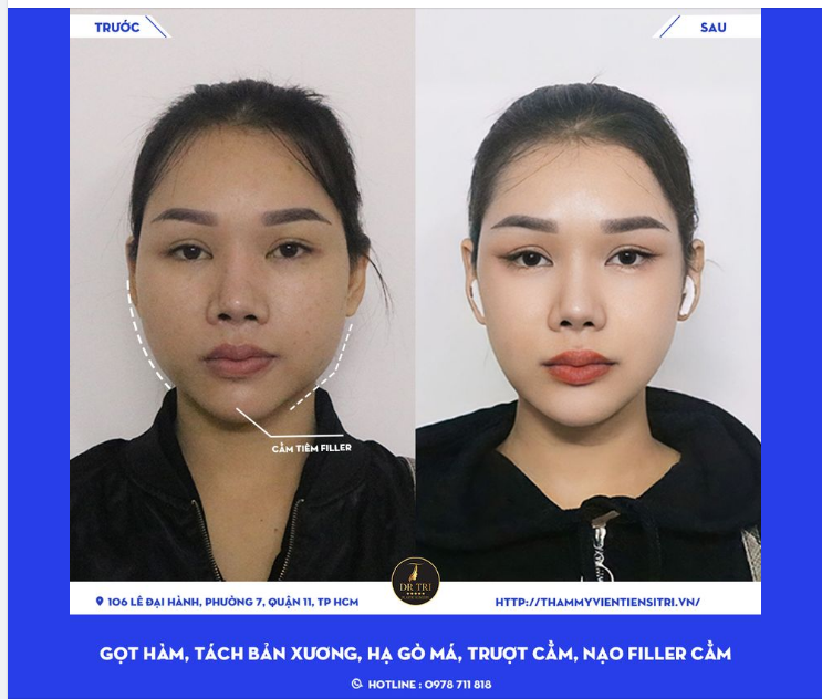 TẠO HÌNH ĐƯỜNG VIỀN MẶT + THU NHỎ MẶT BẰNG COMBO: Hạ gò má, Gọt hàm Trượt cằm Tách bản  xương và Nạo filller cằm