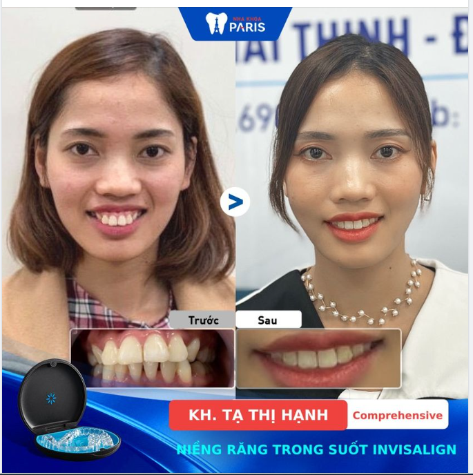 TƯỞNG PHẪU THUẬT THẨM MỸ NHƯNG HÓA RA LẠI LÀ NIỀNG RĂNG