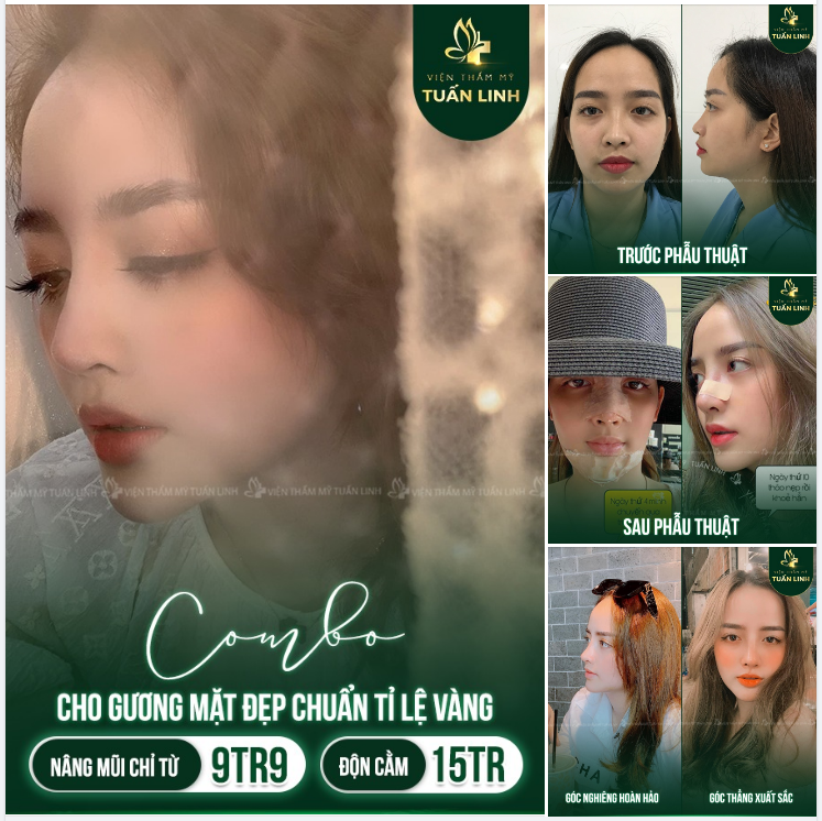 COMBO SIÊU ƯU ĐÃI: Nâng mũi chỉ từ 9TR9 - Độn cằm: 15TR - Hỗ trợ trả góp 0% Lãi - Chỉ cần CCCD gắn chip.