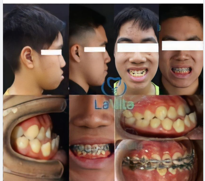 Khớp cắn ngược là một trong những trường hợp bất thường của răng, gây ảnh hưởng nghiêm trọng đến sức khoẻ và thẩm mỹ của người bệnh.