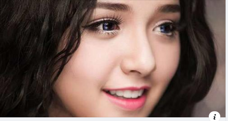 Thời gian phục hồi sau cắt mí diễn ra nhanh hay chậm phụ thuộc rất nhiều vào cách chăm sóc mắt sau cắt mí của chính khách hàng.