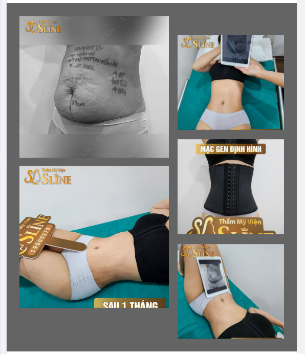 Ngắm body sau 1 tháng hút mỡ.