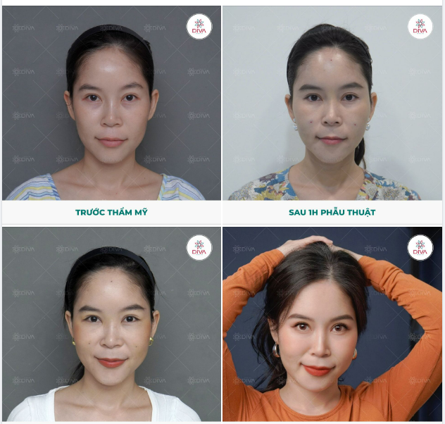 SAU CẤY MỠ COLEMAN MẶT BỊ SƯNG CÓ NGUY HIỂM?
