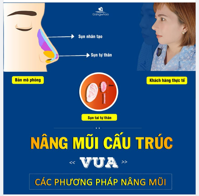 NÂNG MŨI CẤU TRÚC - VUA CÁC PHƯƠNG PHÁP NÂNG MŨI