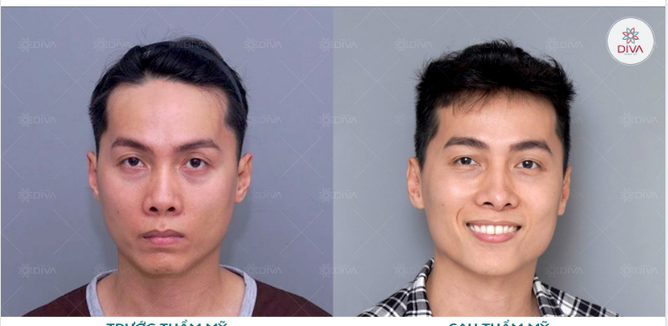 MẶT HỐC HÁC, GIÀ NUA SAU THẨM MỸ HÓA THẦN THÁI TRẺ TRUNG, THU HÚT