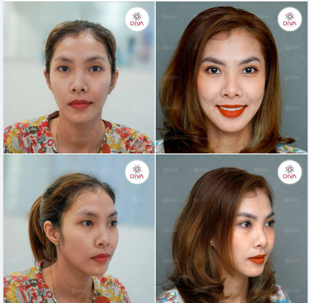 KẾT QUẢ SAU NHẤN MÍ MẮT VĨNH VIỄN TẠI DIVA NHƯ THẾ NÀO?