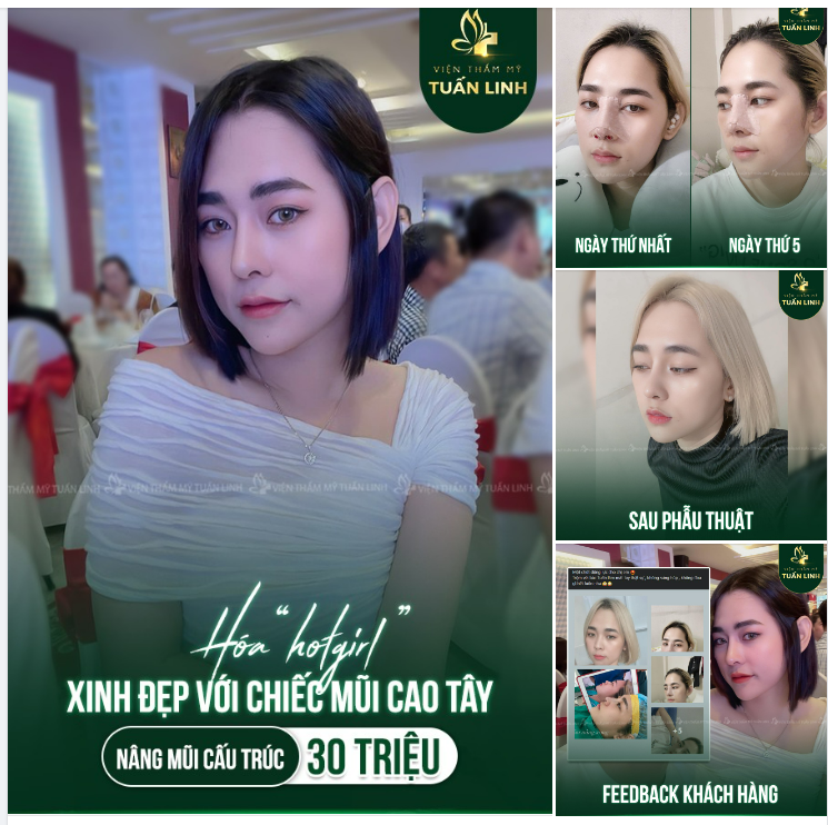 HÓA HOTGIRL XINH ĐẸP CÙNG CHIẾC MŨI CAO XINH!!
