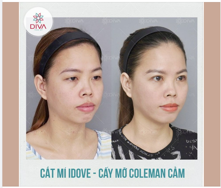 CẢI THIỆN CẰM LẸM, MÍ LÓT, MẮT NHỎ - GƯƠNG MẶT TƯƠI TRẺ, THU HÚT SAU THẨM MỸ