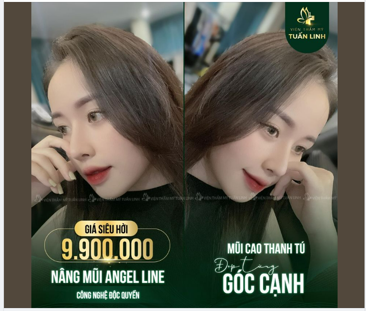 Chỉ với 9TR9 Sở hữu ngay cho mình dáng mũi cao tây pha nét tự nhiên và được thiết kế riêng theo từng khuôn mặt với: