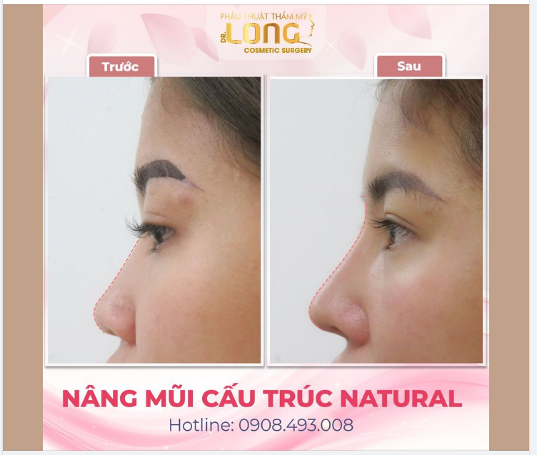 THIẾU TỰ TIN — KHI DÁNG MŨI CHƯA XINH