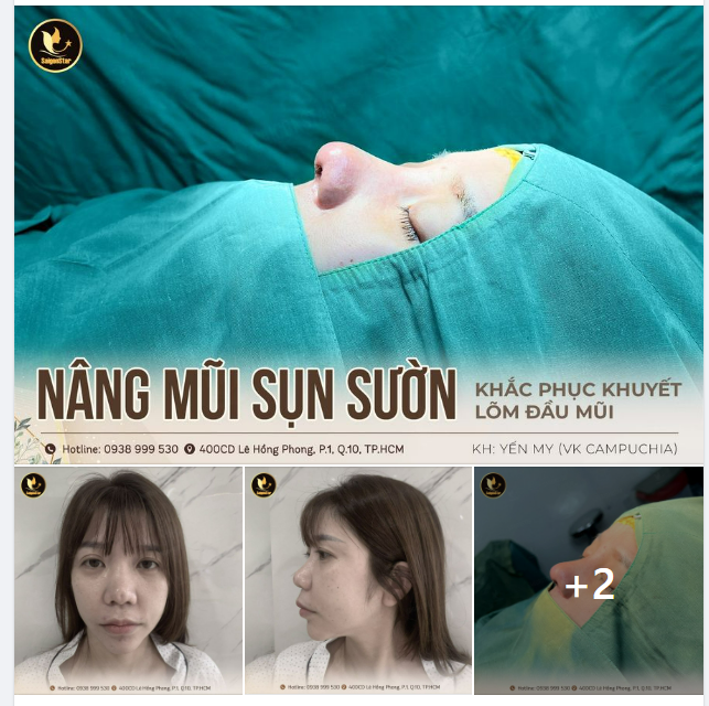 NÂNG MŨI SỤN SƯỜN TÁI SINH NHAN SẮC VIỆT KIỀU CAMPUCHIA THOÁT KHỎI MẶC CẢM