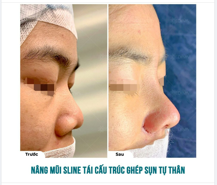 CẢI THIỆN SỐNG MŨI THẤP, CÁNH MŨI TO VỚI NÂNG MŨI SLINE TÁI CẤU TRÚC