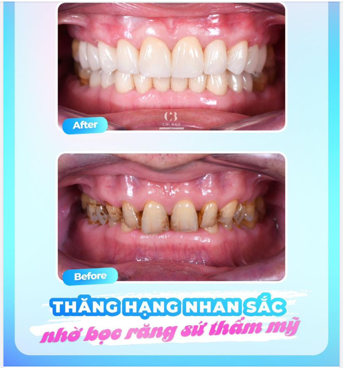 Thăng hạng nhan sắc nhờ bọc răng sứ thẩm mỹ