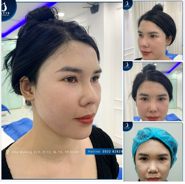 "Chị không nghĩ là có ngày mũi chị đẹp thế này..."