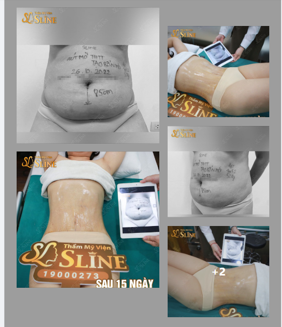 Bụng mỡ đến Sline là y rằng có ngay bụng đẹp đi về.