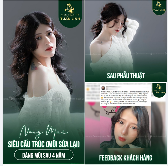 Bạn nào đã từng nâng mũi bị hỏng khi quyết định sửa lại mũi cũng đều rất lo lắng, không biết dáng mũi mới có đẹp được theo mong muốn không, có bền không, có bị biến chứng không???