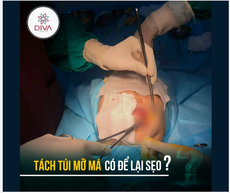 TÁCH TÚI MỠ MÁ CÓ ĐỂ LẠI SẸO?
