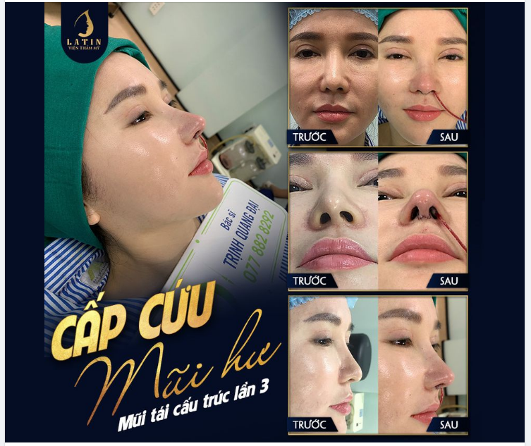 SỬA MŨI HỎNG THÀNH CÔNG GIÚP BẠN THAY ĐỔI NHƯ THẾ NÀO?