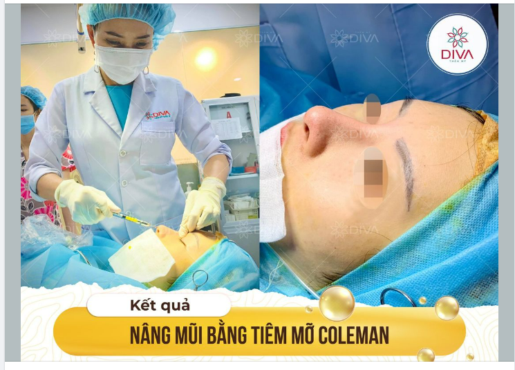 TIÊM MỠ COLEMAN NÂNG CAO SỐNG MŨI