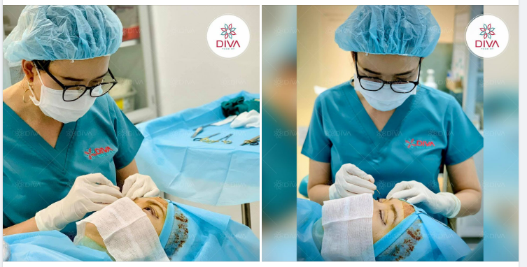 LÀM SAO ĐỂ SAU CẮT MÍ MẮT MÍ KHÔNG BỊ THÔ ?