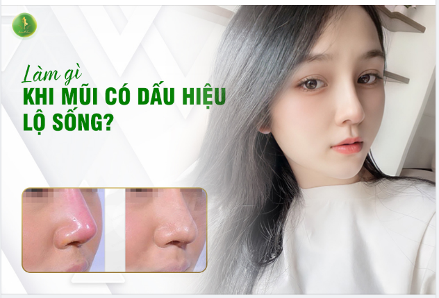 NÊN LÀM GÌ KHI MŨI CÓ DẤU HIỆU LỘ SỐNG