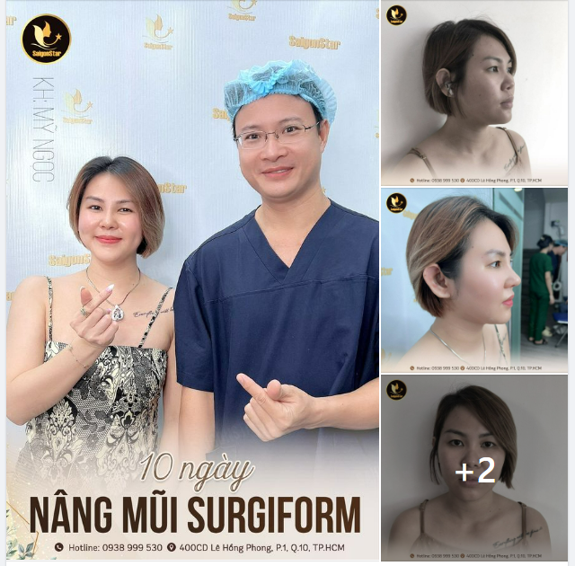 10 NGÀY NÂNG MŨI SURGIFORM  KH: MỸ NGỌC