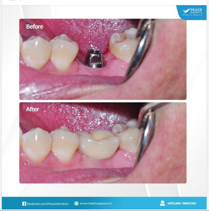Ca lâm sàng cấy ghép 1 đơn vị implant cho khách hàng mất răng hàm, giúp khôi phục trọn vẹn chức năng ăn nhai trọn vẹn, thẩm mỹ nụ cười và ngăn ngừa tiêu xương.