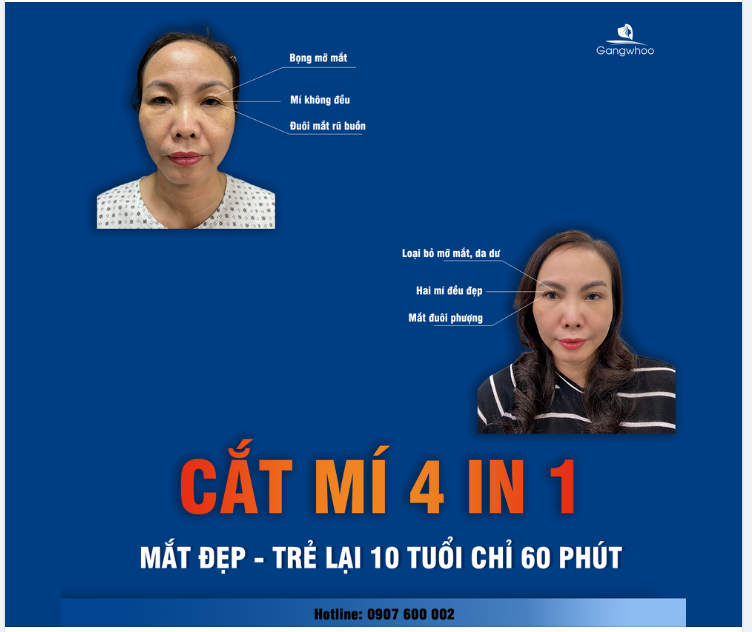 CẮT MÍ 4 IN 1 - MẮT ĐẸP CHỈ SAU 60 PHÚT