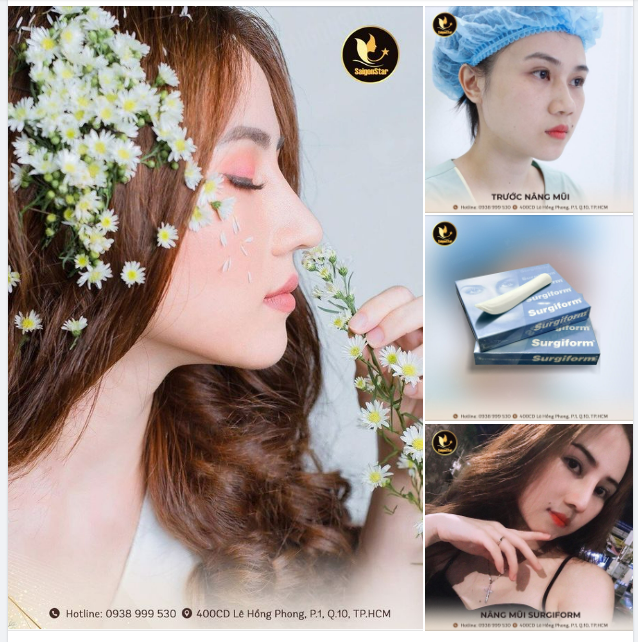 DÁNG MŨI ĐỘC QUYỀN DR. HOẠT SỰ KẾT HỢP HOÀN HẢO SỤN TỰ THÂN VÀ SỤN SINH HỌC SURGIFORM