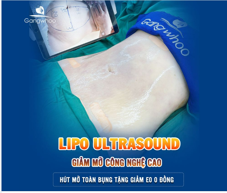 60 PHÚT - GIẢM HƠN 10CM VÒNG BỤNG VỚI TIÊU CHÍ 5 KHÔNG