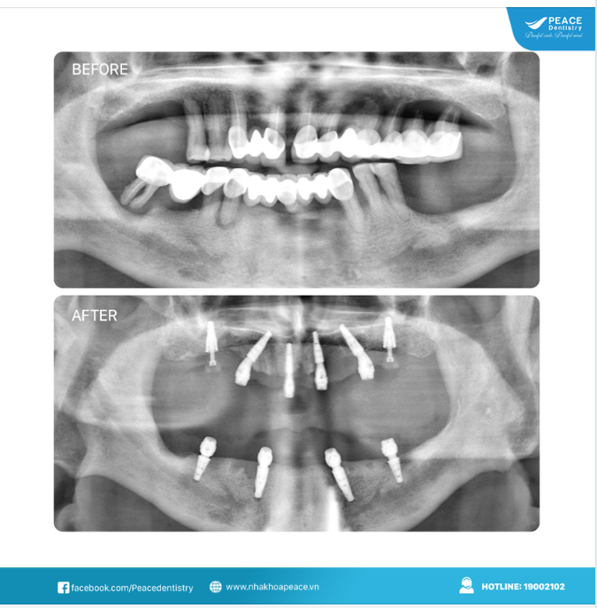 Ca lâm sàng  trồng răng implant toàn hàm cho khách hàng lớn tuổi và một số gợi ý dành cho các Cô Chú mất răng toàn hàm, chỉ  còn ít răng, đang sử dụng cầu răng sứ dài hoặc  hàm tháo lắp.