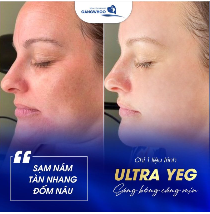 CHỈ 1 LIỆU TRÌNH ULTRA YEG CÔNG NGHỆ ĐIỀU TRỊ NÁM GIÚP DA SÁNG BÓNG CĂNG MỊN